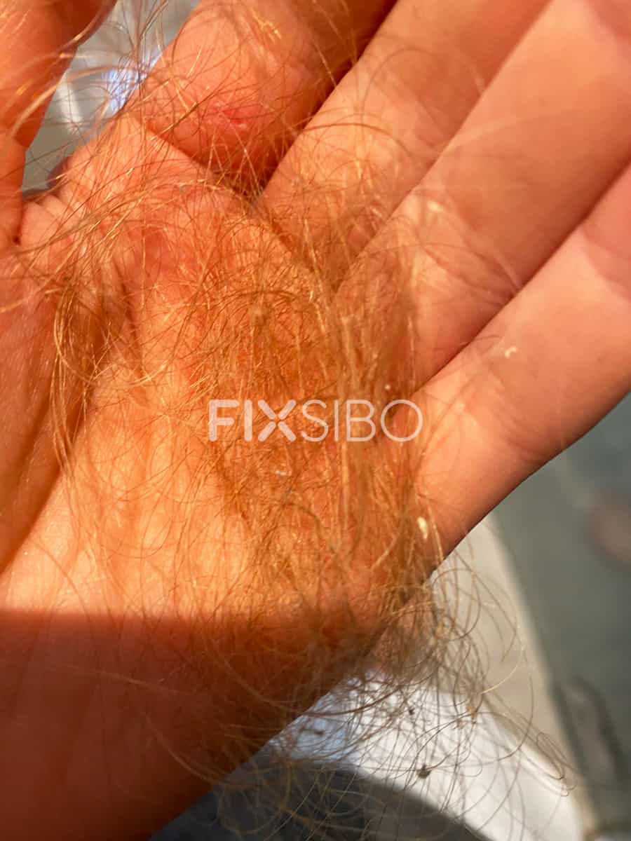 FixSIBO Patient Experience SIBO and Hair Loss 06